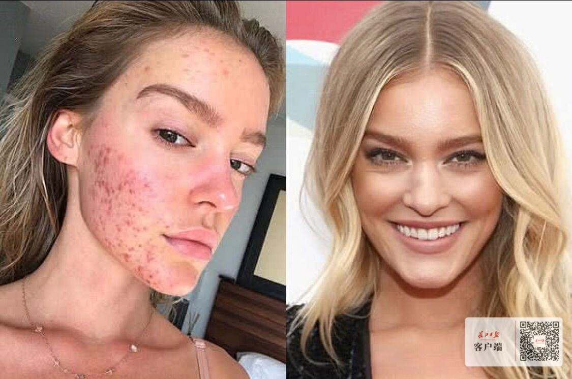 澳24岁超模狂砸10万治痘痘无果，结果竟被中医治愈
