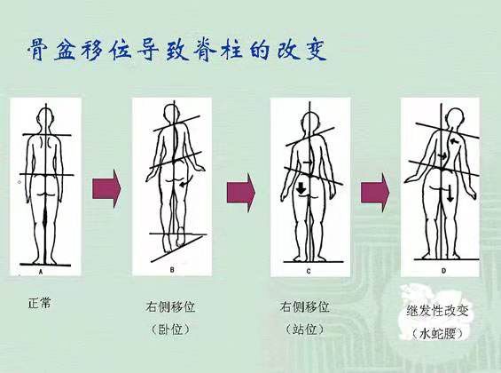 女人骨盆移位怎么造成的,女性骨盆倾斜的纠正手法
