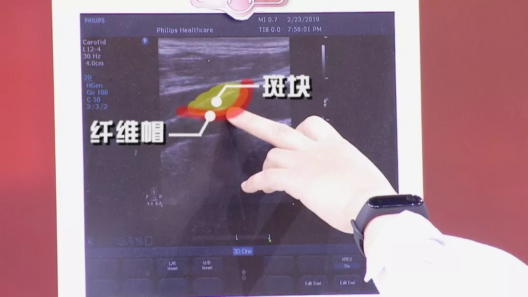 北京卫视养生堂治脑梗食疗,预防脑梗养生堂