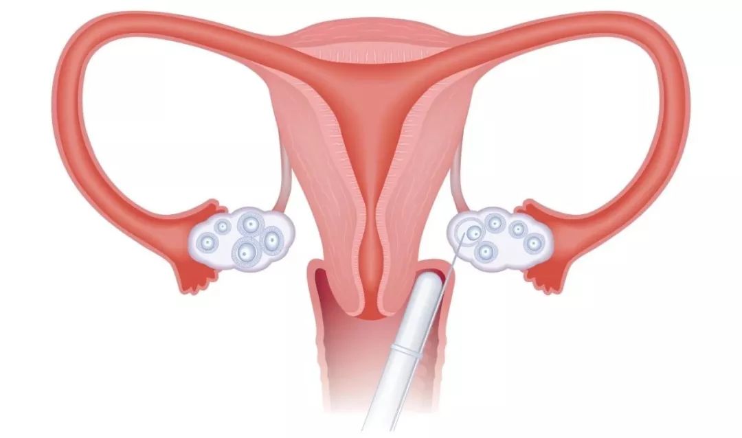 如果不要孩子该怎么办,不要孩子后悔的后果