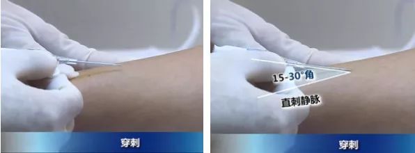 扎留置针有回血送针失败,留置针回血穿刺失败