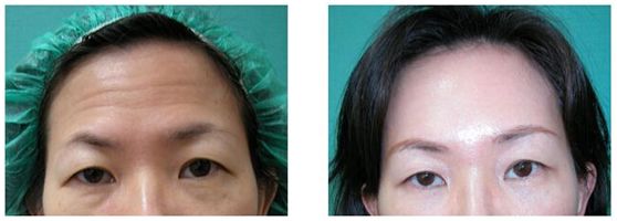 外用涂抹式肉毒素可以祛皱纹吗,去皱纹的肉毒素一年打几次为佳