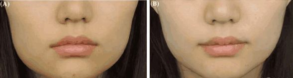 外用涂抹式肉毒素可以祛皱纹吗,去皱纹的肉毒素一年打几次为佳