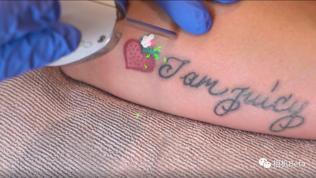 激光洗纹身真的不会留疤吗,索尼a7s2斑马纹