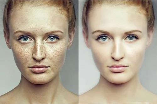 严重痘印晒斑,5个祛斑小妙招淡化晒斑雀斑痘印