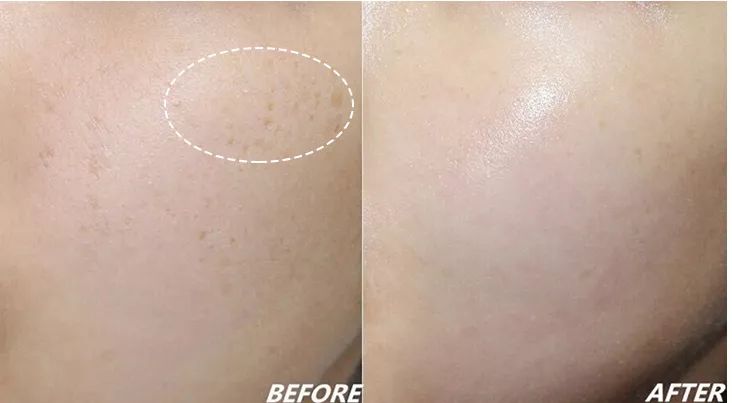 严重痘印晒斑,5个祛斑小妙招淡化晒斑雀斑痘印