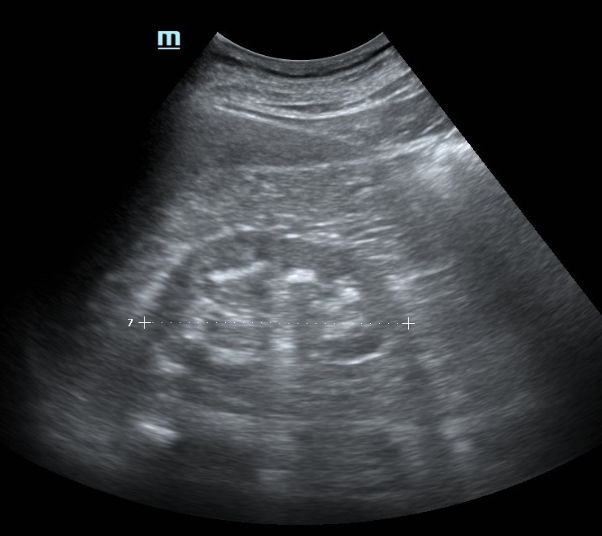 超声技术在肾性高血压中的应用