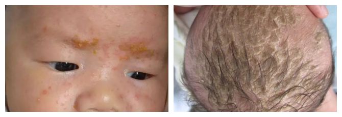 宝宝得了湿疹皮炎怎么办,婴儿特殊类型的湿疹以及皮炎