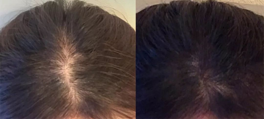 养发防脱拯救发际线洗发水,生发发际线的神器测评