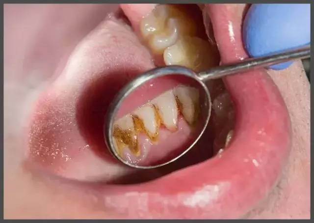 记忆手柄牙刷，刷新想象！1支=5支普通牙刷+1瓶漱口水+1瓶口香糖