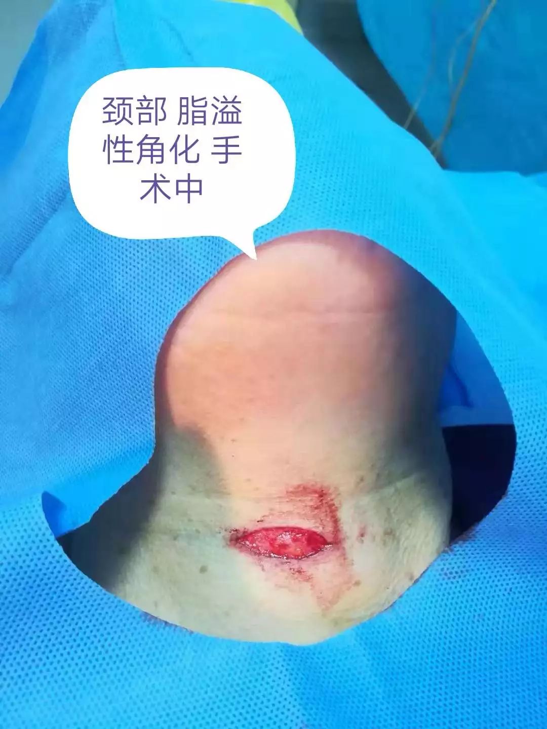 小小黑痣该不该治？该如何治？