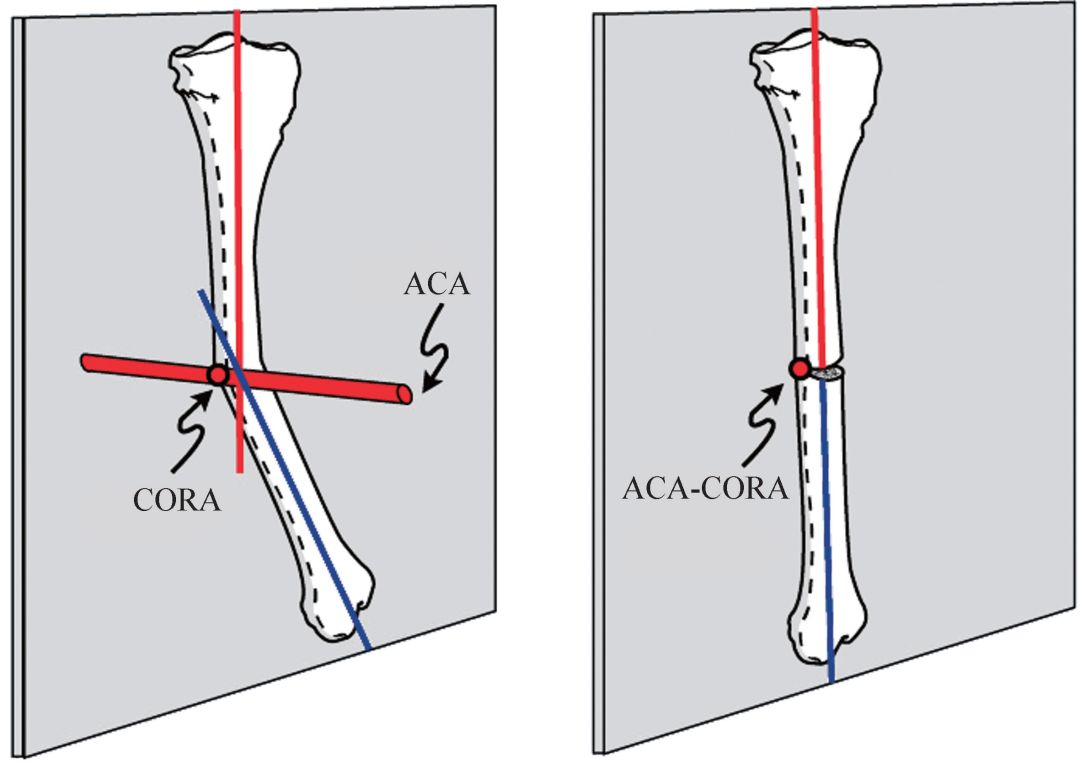 taylorswift支架,taylor外固定支架