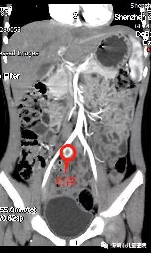 六岁的她每天都用“姨妈巾”,罪魁祸首是……家长注意,这怪病“偏爱”女孩