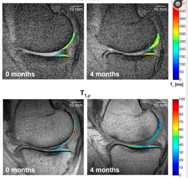 膝关节软骨退化干细胞治疗,间充质干细胞治疗膝关节