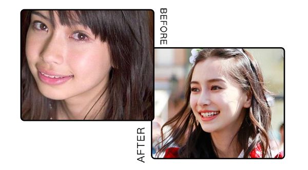 戴牙套整牙的全过程,隐形牙套换头