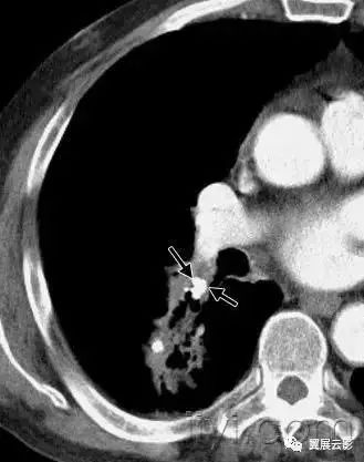 胸部解剖及常见疾病影像表现,胸部影像学基础知识