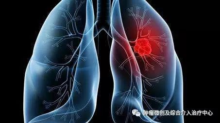 肺癌微创术用的什么机器,介入治疗肿瘤新技术