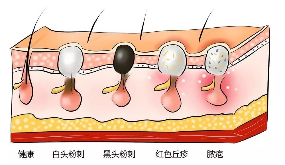 去黑头小妙招超全去黑头方法汇总,去黑头干货科普如何有效战胜黑头