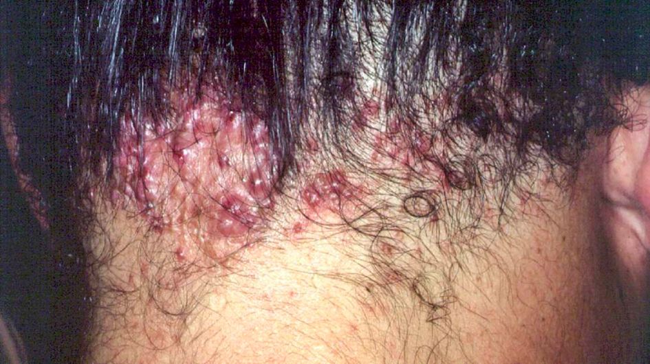 哪种皮肤病容易被误判为银屑病,容易被误诊为疥疮的皮肤病