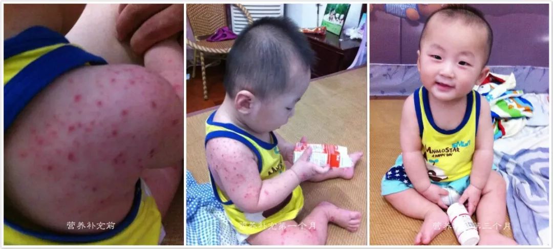 湿疹这场持久战日常护理重点在哪,湿疹的护理措施及健康教育指导