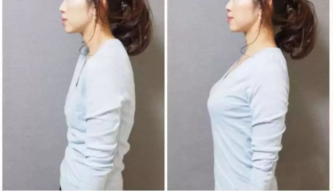 含胸驼背最损气质手把手教你纠正,含胸驼背如何改善提升气质