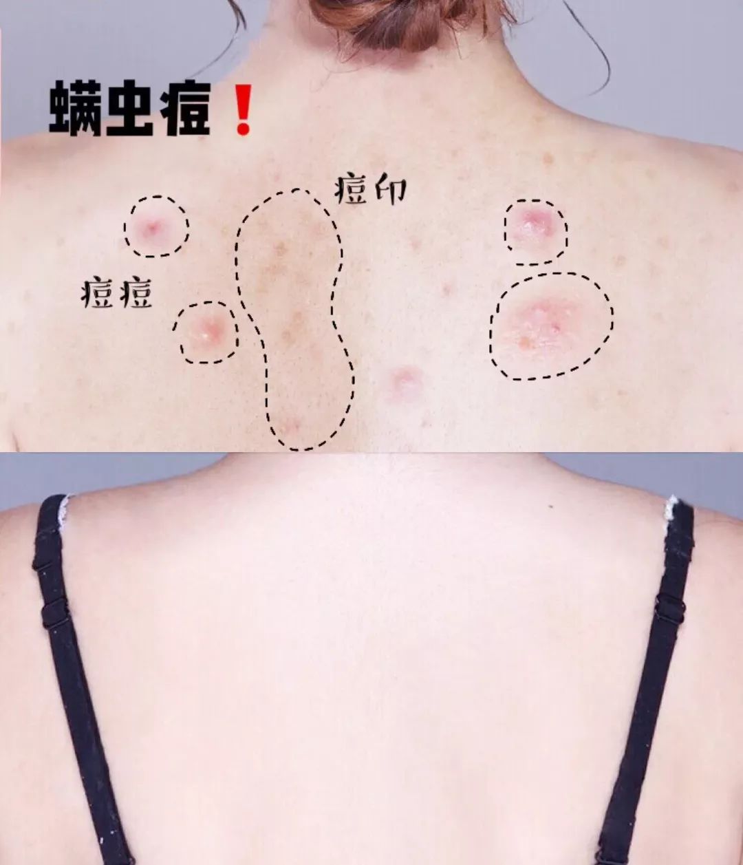 皮肤清洁出黑色的东西,皮肤挤出白色膏状很臭怎么办