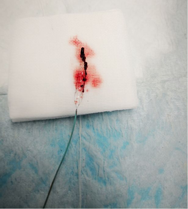 径技·例量|25期：再灌注出血—防不胜防