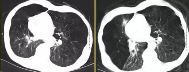 支气管镜热消融术治疗慢阻肺,西京医院支气管镜
