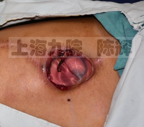 点黑痣后用什么修复最好,黑色素痣扩张术是什么原理