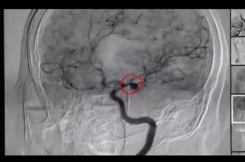 吉林省哪个医院做脑动脉瘤最好,吉林省神经精神病医院精神科