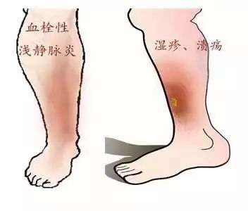 关于静脉曲张你知道多少？多图带你深入了解静脉曲张！