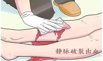 关于静脉曲张你知道多少?多图带你深入了解静脉曲张!