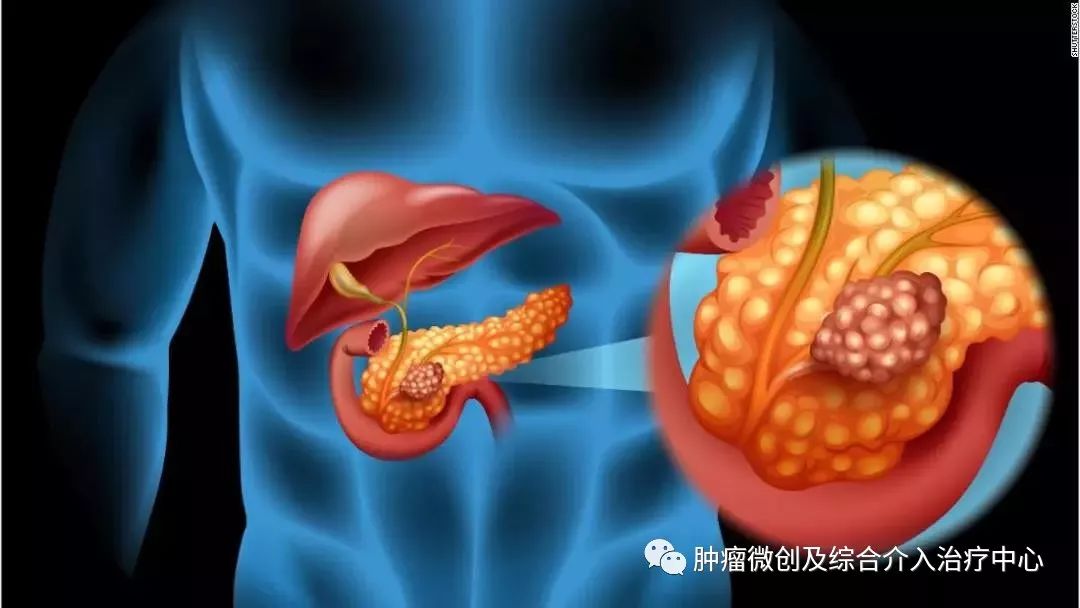 胰腺癌的介入治疗是什么意思？胰腺长瘤能活多久？-运城市第一医院肿瘤微创及综合介入科