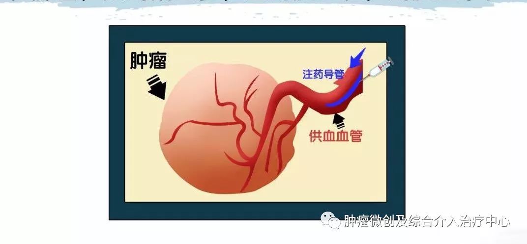 胰腺癌的介入治疗是什么意思？胰腺长瘤能活多久？-运城市第一医院肿瘤微创及综合介入科