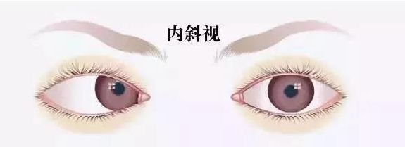 宁德5岁女娃患特殊斗鸡眼，每天左右眼交替…医生的治疗方法惊呆家长