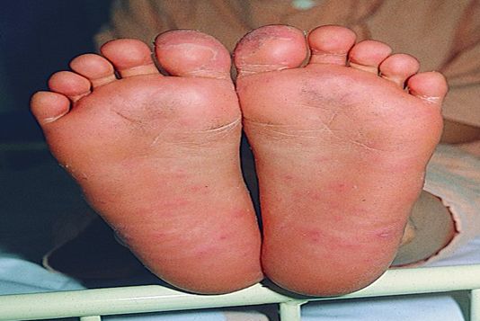 手足口病疫苗是预防终身吗,ev71手足口病疫苗潮州哪里有得打