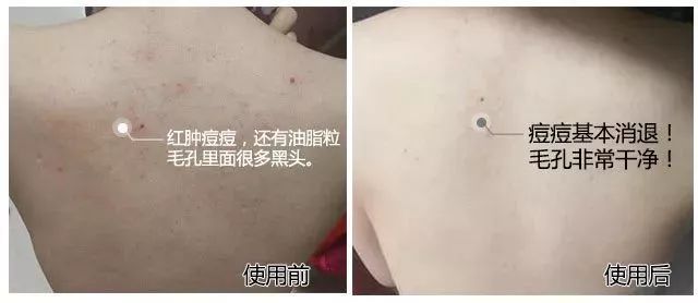 鸡皮肤永久消除,37天快速祛鸡皮肤