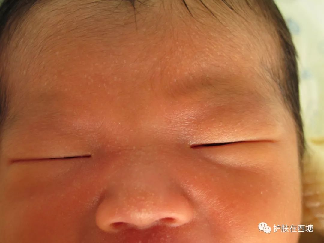 头皮脂溢性皮炎怎么彻底根除,毛囊炎和脂溢性皮炎的区别图