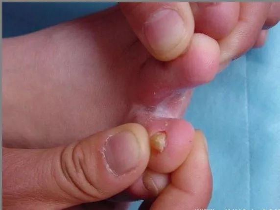 夏季脚气的最佳治疗方法,夏季脚气根治方法