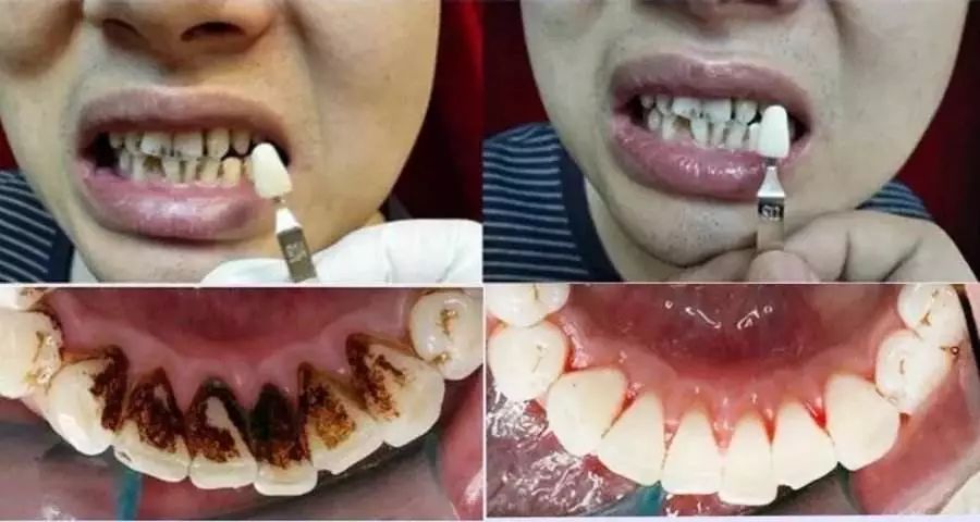 去除黄牙牙垢的牙膏,去口臭黄牙牙垢的牙膏