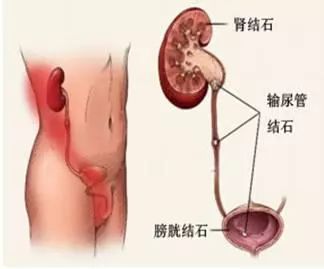 我院泌尿外科举办“科普小课堂”为住院患者及家属普及健康知识