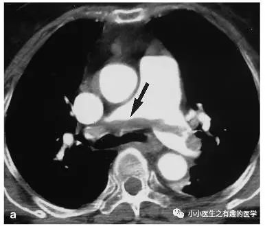ct平扫肺部能查出是哮喘吗,ct平扫肺结节准确吗