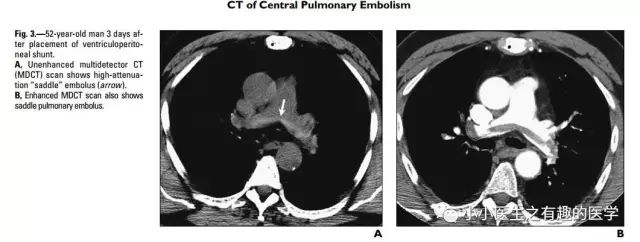 ct平扫肺部能查出是哮喘吗,ct平扫肺结节准确吗