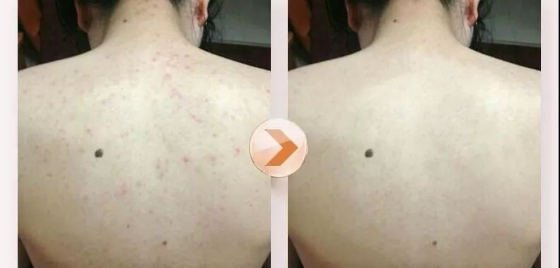 教你1分钟清除99%的脸上螨虫,10秒祛螨虫的药膏