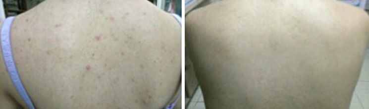 20分钟清理背部螨虫痘痘,十秒去除螨虫