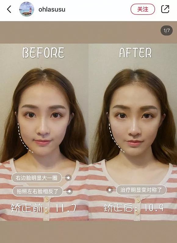 不动刀的整容,不动刀脸部轮廓紧致