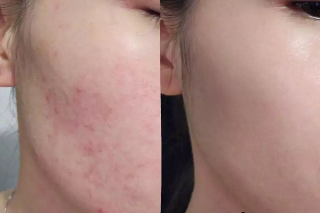 断货王祛痘胶囊,秒杀祛痘化妆品一元