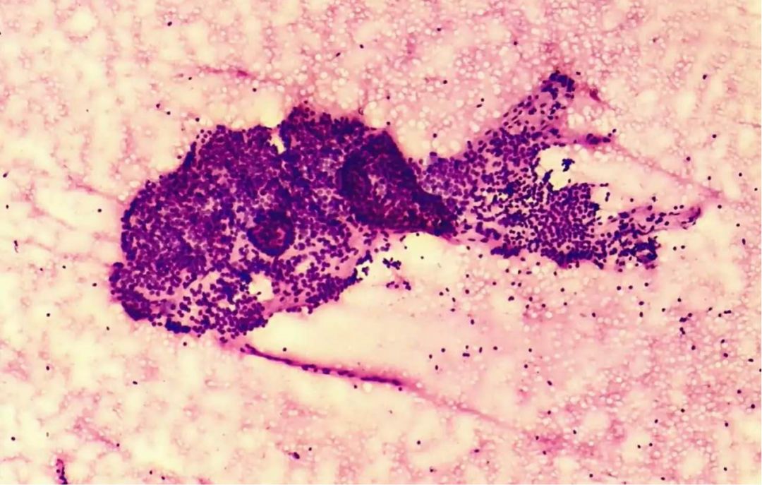 试述甲状腺结节的诊断思路,甲状腺结节病理诊断单怎么看