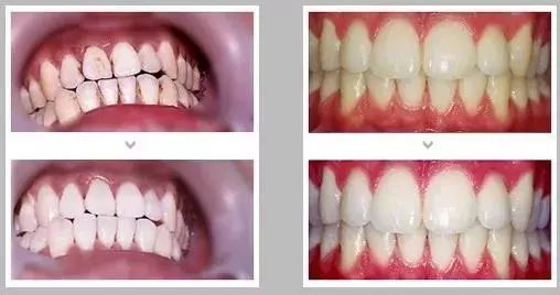 不用打磨牙齿的快速美白方法,不用洗牙能把牙垢黄牙变白的方法