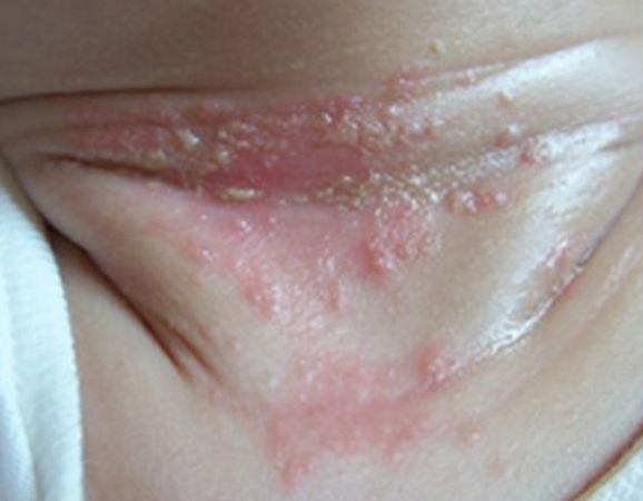 治疗痱子的8个妙招,有关治痱子的小妙招